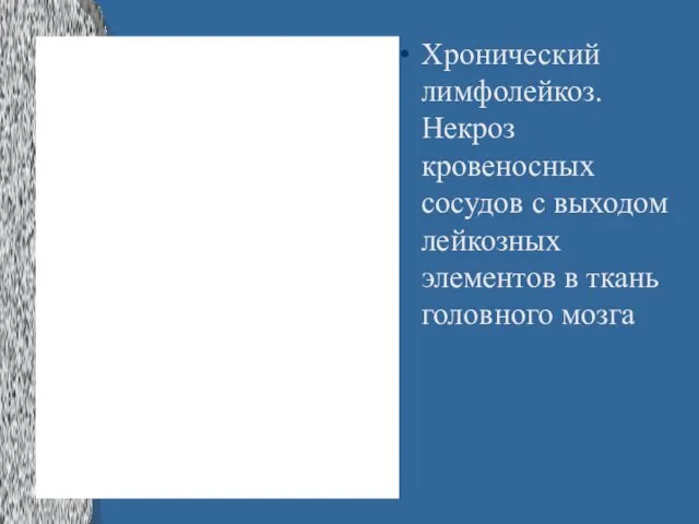 Хронический лимфолейкоз. Некроз кровеносных сосудов с выходом лейкозных элементов в ткань головного мозга