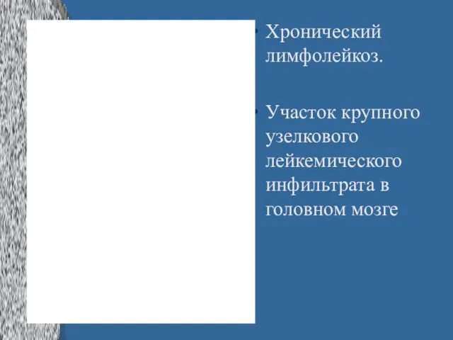 Хронический лимфолейкоз. Участок крупного узелкового лейкемического инфильтрата в головном мозге