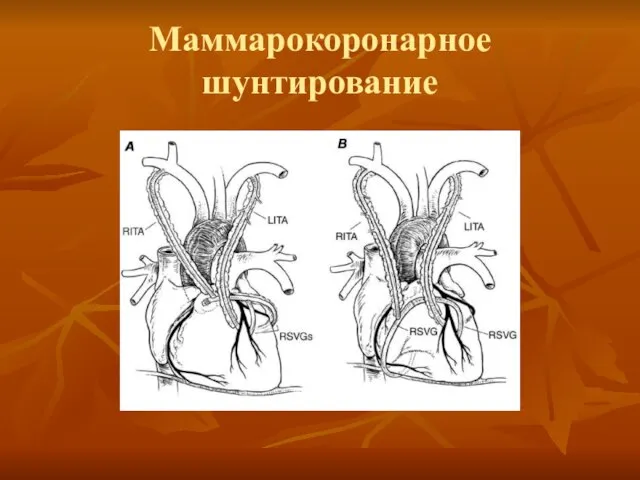 Маммарокоронарное шунтирование