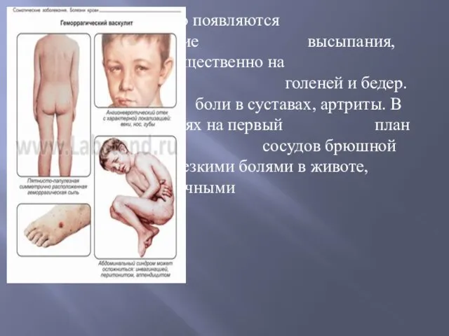 Чаще всего появляются мелкие геморрагические высыпания, преимущественно на передней поверхности голеней и