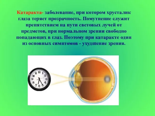 Катаракта- заболевание, при котором хрусталик глаза теряет прозрачность. Помутнение служит препятствием на