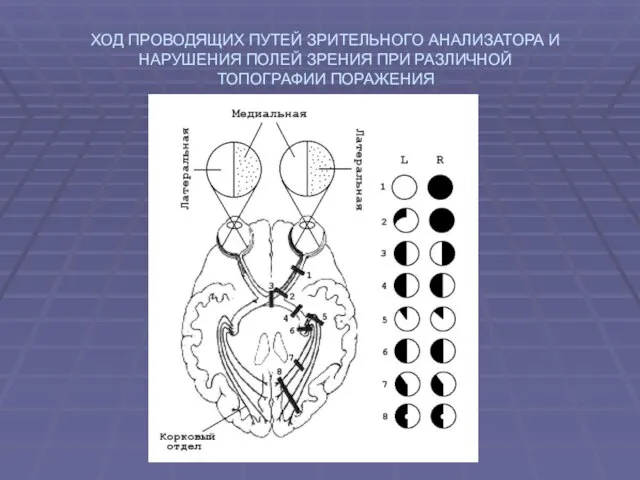 ХОД ПРОВОДЯЩИХ ПУТЕЙ ЗРИТЕЛЬНОГО АНАЛИЗАТОРА И НАРУШЕНИЯ ПОЛЕЙ ЗРЕНИЯ ПРИ РАЗЛИЧНОЙ ТОПОГРАФИИ ПОРАЖЕНИЯ