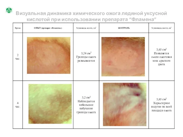 Визуальная динамика химического ожога ледяной уксусной кислотой при использовании препарата “Фламена”