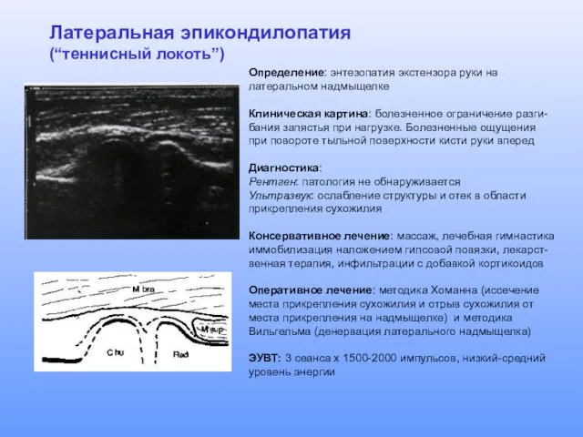 Латеральная эпикондилопатия (“теннисный локоть”) Определение: энтезопатия экстензора руки на латеральном надмыщелке Клиническая