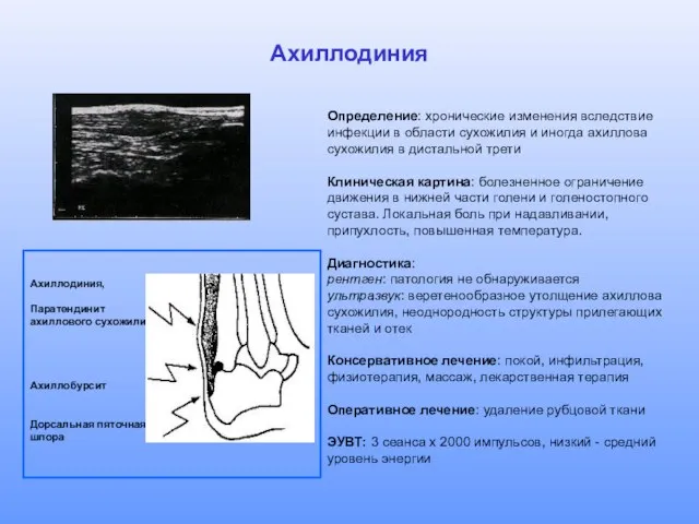 Ахиллодиния Определение: хронические изменения вследствие инфекции в области сухожилия и иногда ахиллова