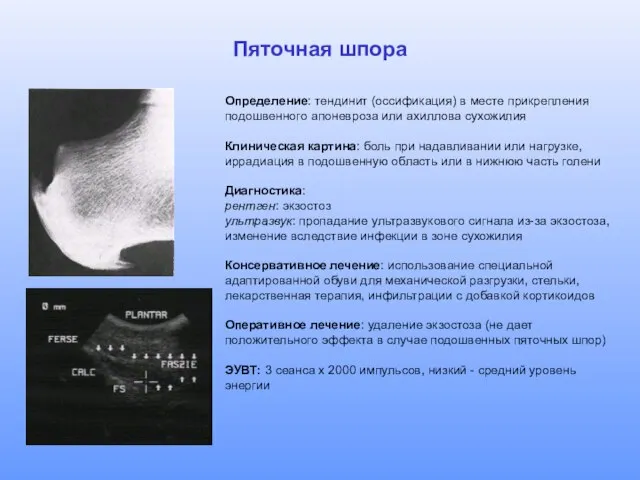 Пяточная шпора Определение: тендинит (оссификация) в месте прикрепления подошвенного апоневроза или ахиллова