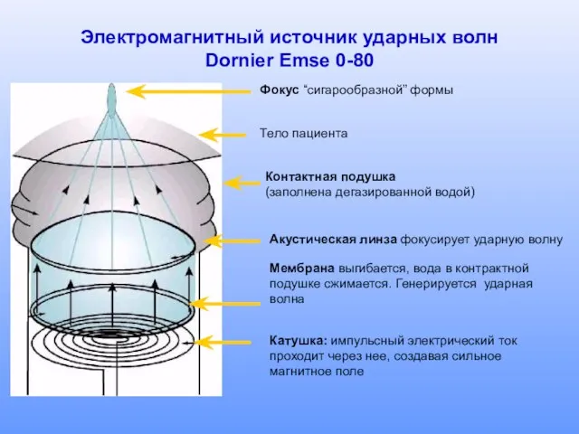 Электромагнитный источник ударных волн Dornier Emse 0-80 Фокус “сигарообразной” формы Тело пациента