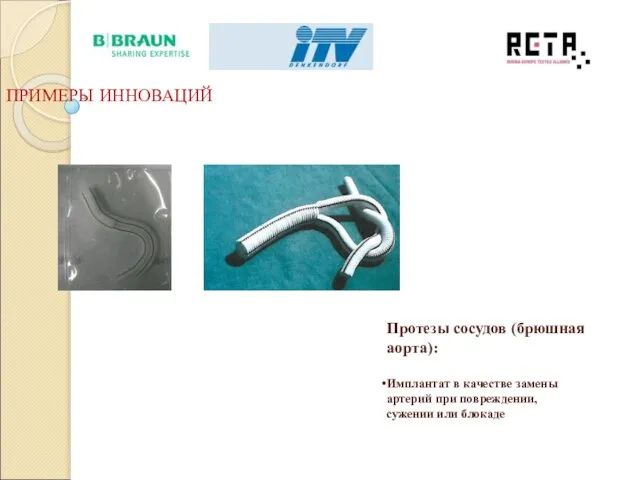 Протезы сосудов (брюшная аорта): Имплантат в качестве замены артерий при повреждении, сужении или блокаде ПРИМЕРЫ ИННОВАЦИЙ
