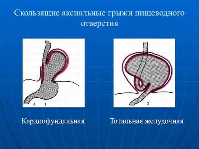 Скользящие аксиальные грыжи пищеводного отверстия Кардиофундальная Тотальная желудочная