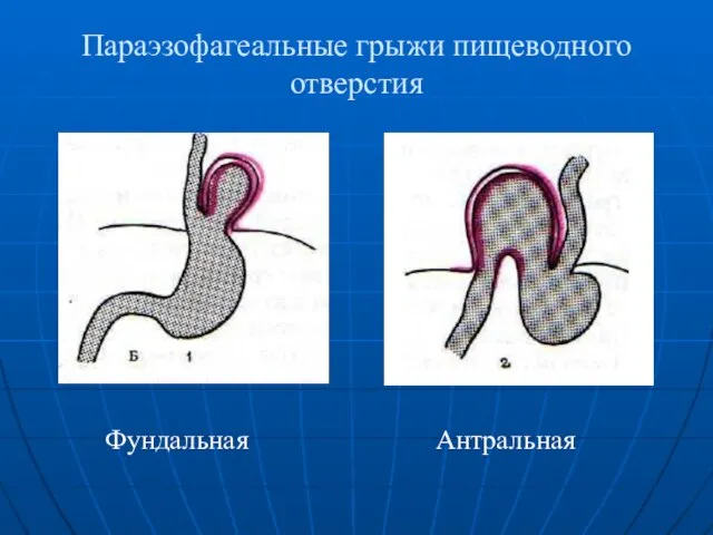 Параэзофагеальные грыжи пищеводного отверстия Фундальная Антральная