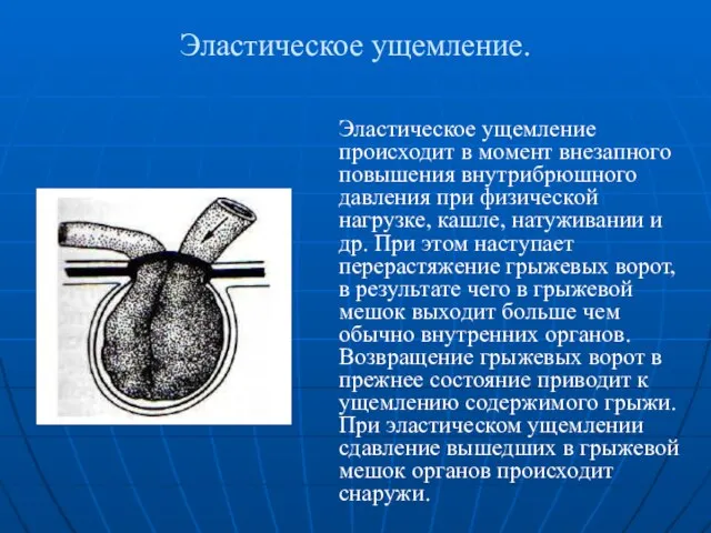 Эластическое ущемление. Эластическое ущемление происходит в момент внезапного повышения внутрибрюшного давления при