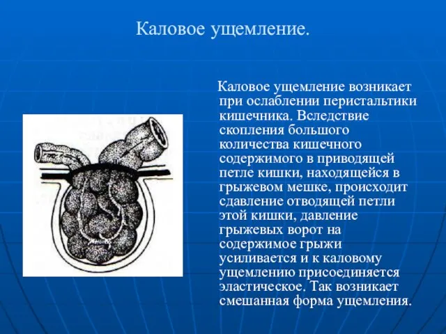 Каловое ущемление. Каловое ущемление возникает при ослаблении перистальтики кишечника. Вследствие скопления большого