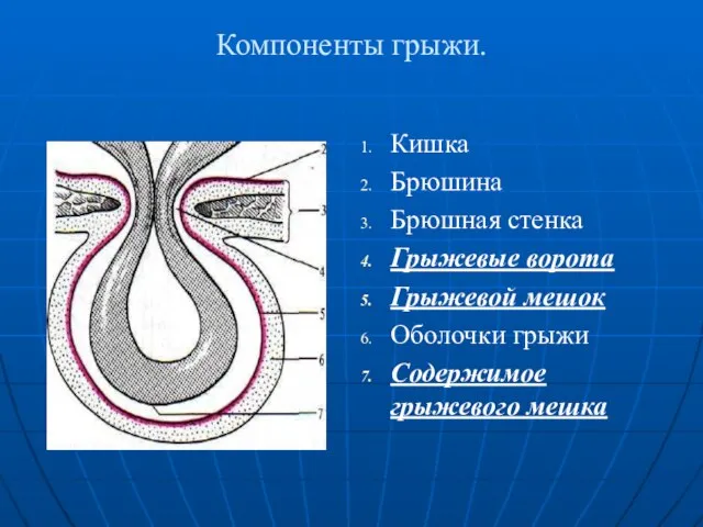 Компоненты грыжи. Кишка Брюшина Брюшная стенка Грыжевые ворота Грыжевой мешок Оболочки грыжи Содержимое грыжевого мешка