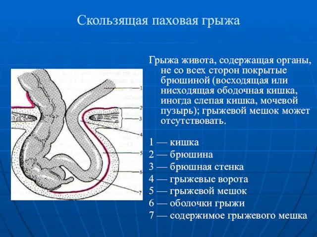 Скользящая паховая грыжа Грыжа живота, содержащая органы, не со всех сторон покрытые