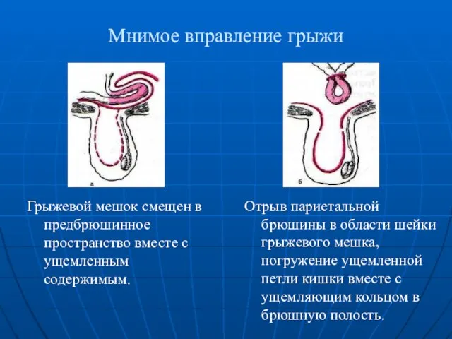 Мнимое вправление грыжи Грыжевой мешок смещен в предбрюшинное пространство вместе с ущемленным