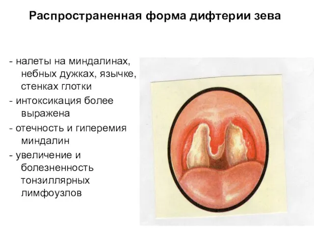 Распространенная форма дифтерии зева - налеты на миндалинах, небных дужках, язычке, стенках