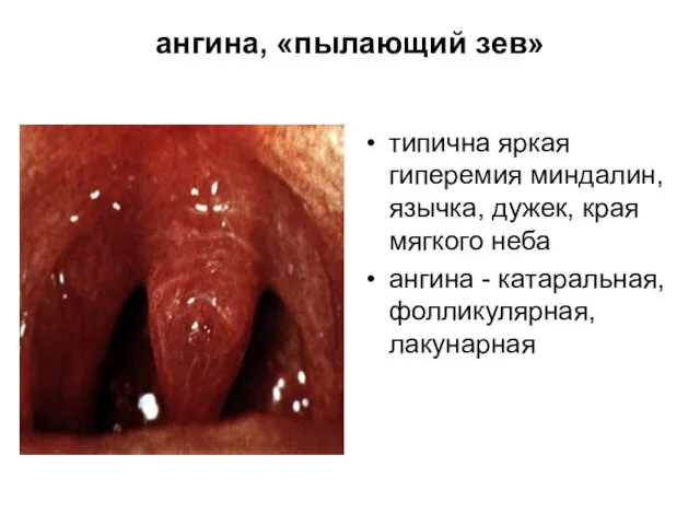 ангина, «пылающий зев» типична яркая гиперемия миндалин, язычка, дужек, края мягкого неба