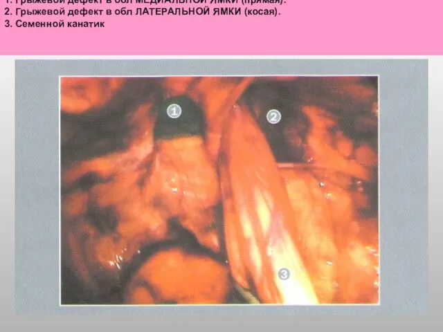 1. Грыжевой дефект в обл МЕДИАЛЬНОЙ ЯМКИ (прямая). 2. Грыжевой дефект в