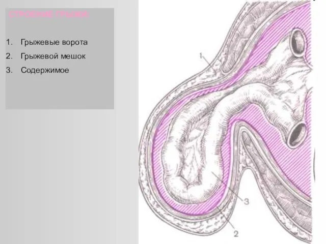СТРОЕНИЕ ГРЫЖИ: Грыжевые ворота Грыжевой мешок Содержимое