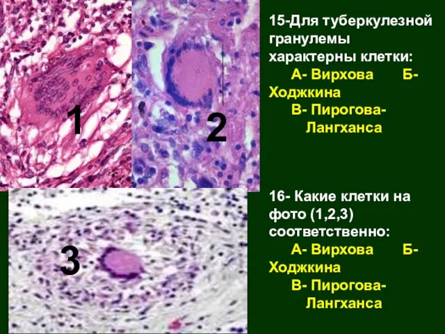 15-Для туберкулезной гранулемы характерны клетки: А- Вирхова Б- Ходжкина В- Пирогова- Лангханса