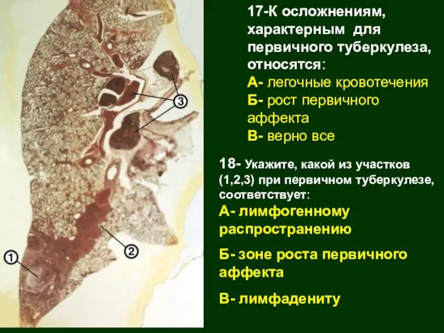 17-К осложнениям, характерным для первичного туберкулеза, относятся: А- легочные кровотечения Б- рост