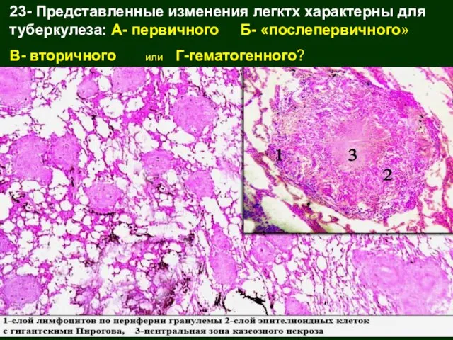 23- Представленные изменения легктх характерны для туберкулеза: А- первичного Б- «послепервичного» В- вторичного или Г-гематогенного?