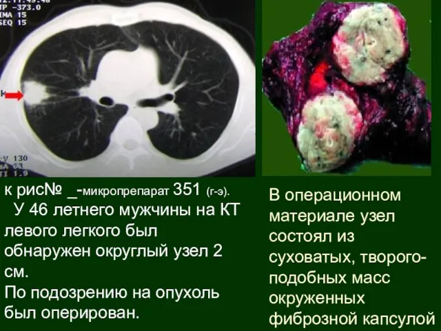 к рис№ _-микропрепарат 351 (г-э). У 46 летнего мужчины на КТ левого