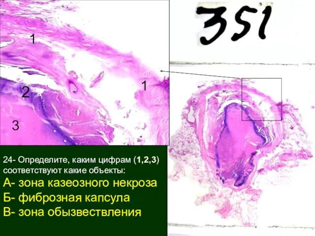 24- Определите, каким цифрам (1,2,3) соответствуют какие объекты: А- зона казеозного некроза