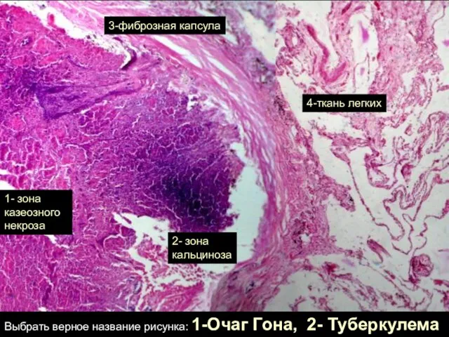 1- зона казеозного некроза 3-фиброзная капсула 4-ткань легких 2- зона кальциноза Выбрать
