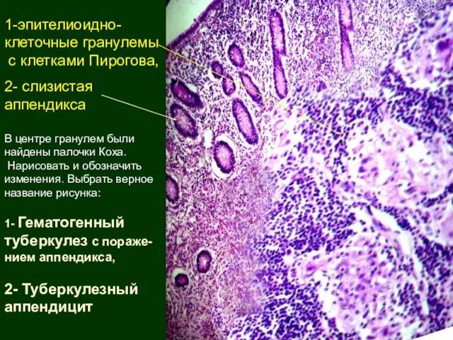 1-эпителиоидно-клеточные гранулемы с клетками Пирогова, 2- слизистая аппендикса В центре гранулем были