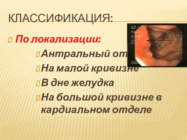 КЛАССИФИКАЦИЯ: По локализации: Антральный отдел На малой кривизне В дне желудка На