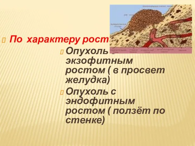 По характеру роста: Опухоль с экзофитным ростом ( в просвет желудка) Опухоль