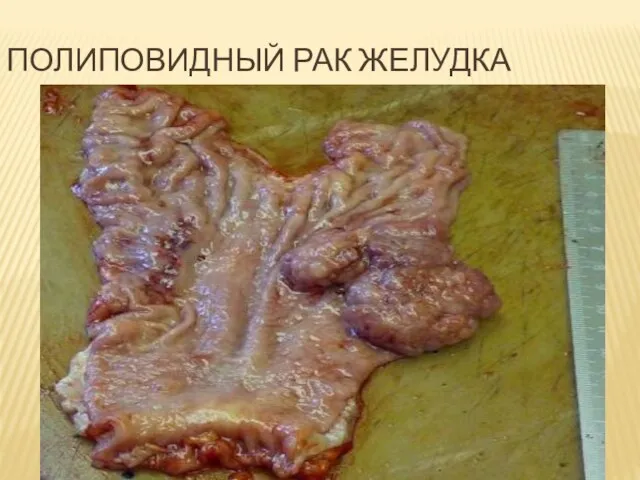 ПОЛИПОВИДНЫЙ РАК ЖЕЛУДКА