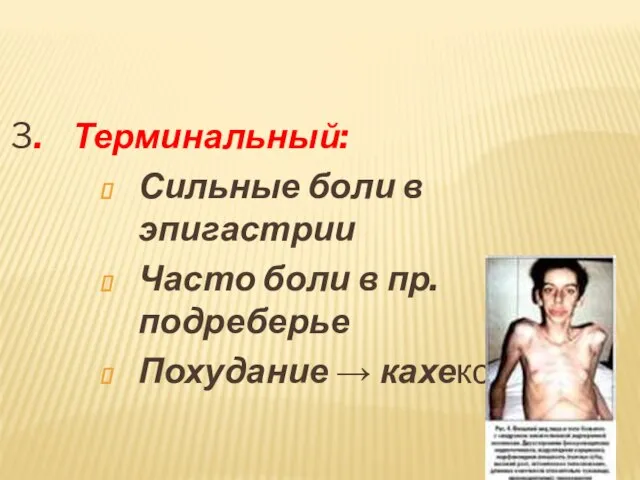 3. Терминальный: Сильные боли в эпигастрии Часто боли в пр. подреберье Похудание → кахексия