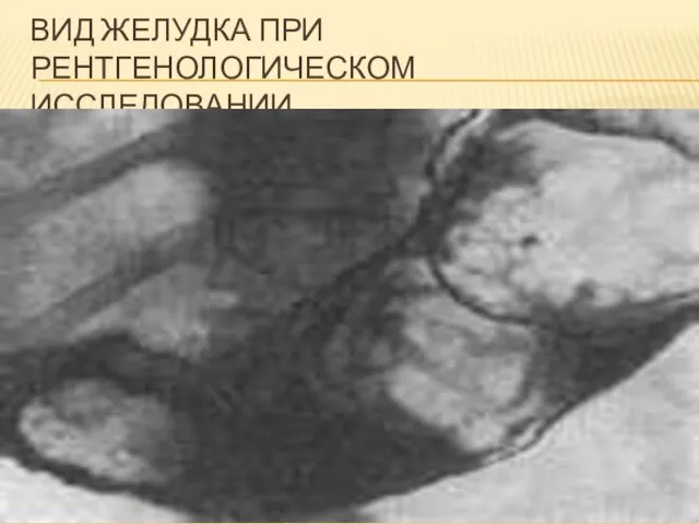 ВИД ЖЕЛУДКА ПРИ РЕНТГЕНОЛОГИЧЕСКОМ ИССЛЕДОВАНИИ.