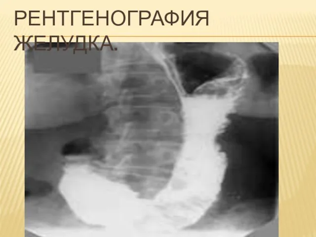 РЕНТГЕНОГРАФИЯ ЖЕЛУДКА.