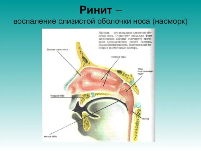 Ринит – воспаление слизистой оболочки носа (насморк)