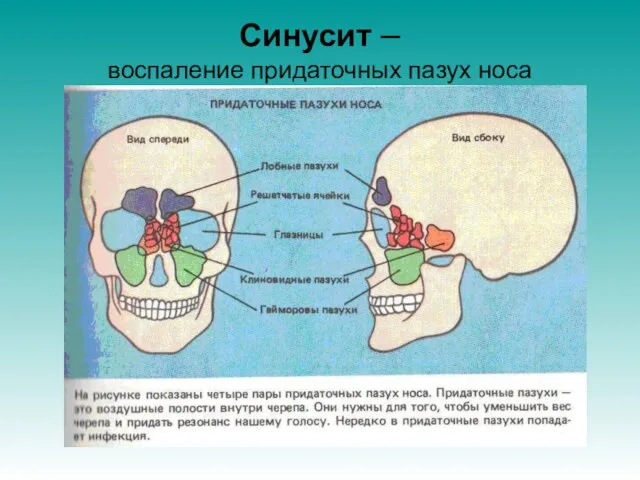 Синусит – воспаление придаточных пазух носа