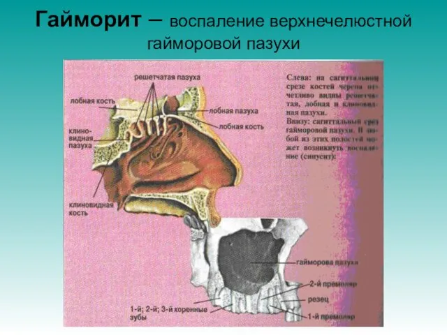 Гайморит – воспаление верхнечелюстной гайморовой пазухи