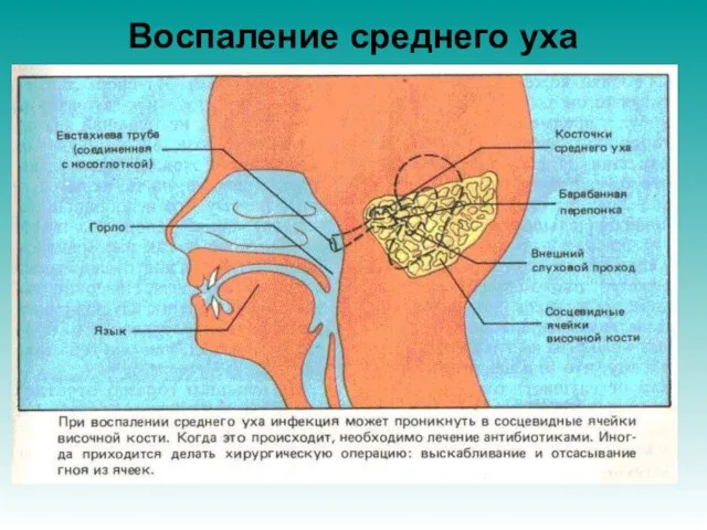 Воспаление среднего уха