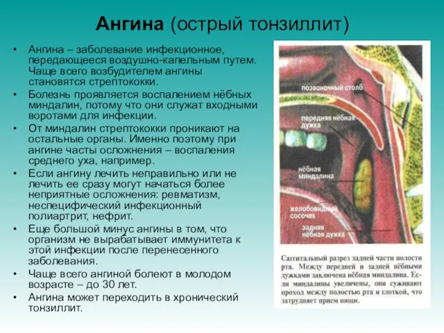 Ангина (острый тонзиллит) Ангина – заболевание инфекционное, передающееся воздушно-капельным путем. Чаще всего