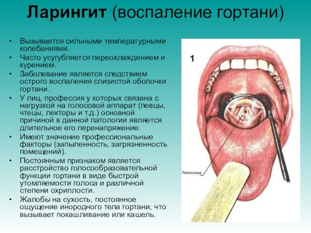 Ларингит (воспаление гортани) Вызывается сильными температурными колебаниями. Часто усугубляется переохлаждением и курением.