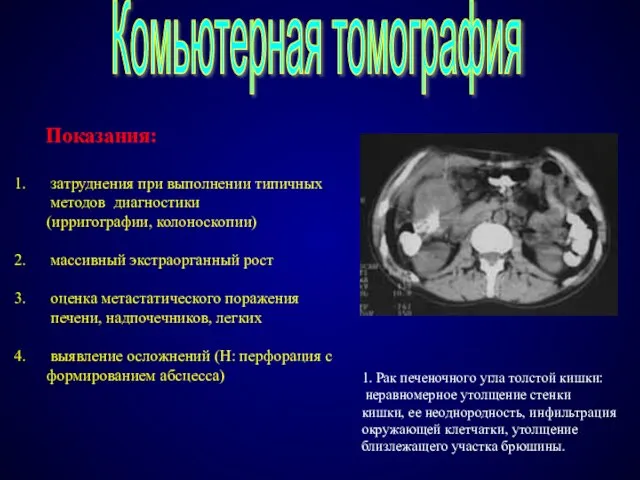 Комьютерная томография Показания: затруднения при выполнении типичных методов диагностики (ирригографии, колоноскопии) массивный