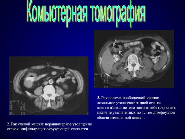 Комьютерная томография 2. Рак слепой кишки: неравномерное утолщение стенок, инфильтрация окружающей клетчатки.