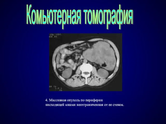 4. Массивная опухоль по периферии нисходящей кишки неотграниченная от ее стенок. Комьютерная томография