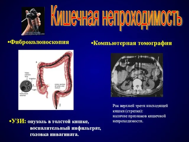 Кишечная непроходимость Фиброколоноскопия УЗИ: опухоль в толстой кишке, воспалительный инфильтрат, головка инвагината.