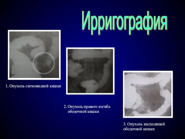 Ирригография 2. Опухоль правого изгиба ободочной кишки 3. Опухоль нисходящей ободочной кишки 1. Опухоль сигмовидной кишки