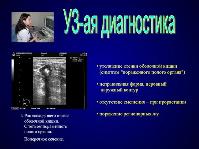 УЗ-ая диагностика 1. Рак восходящего отдела ободочной кишки. Симптом пораженного полого органа.