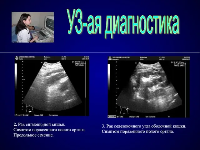 УЗ-ая диагностика 3. Рак селезеночного угла ободочной кишки. Симптом пораженного полого органа.