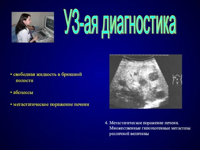 УЗ-ая диагностика 4. Метастатическое поражение печени. Множественные гипоэхогенные метастазы различной величины свободная